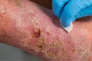 venous ulcer - Pedes Orange County