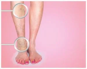 women and varicose veins