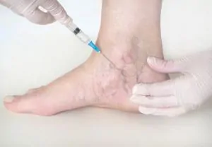 varicose vein treatment women