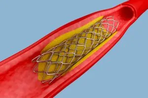 stenting