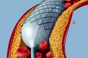 angioplasty