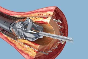 atherectomy