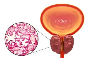 Enlarged prostate for Prostate Artery Embolization