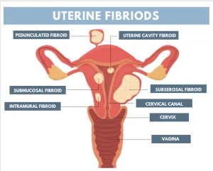 Diagram of Uterine Fibroids