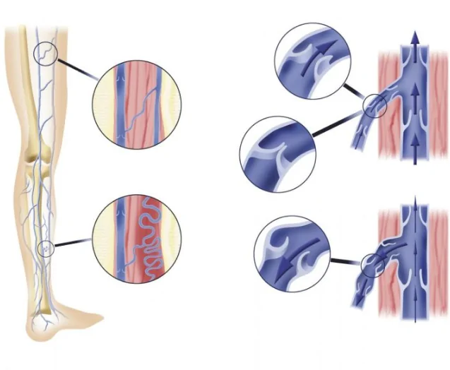 chronic venous insufficiency risk
