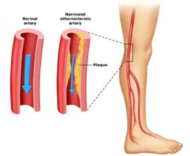 peripheral arterial disease risk