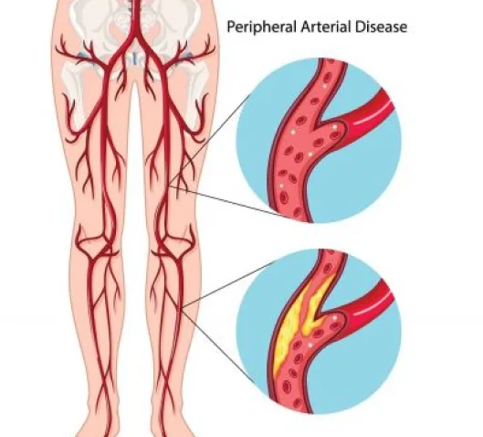 peripheral arterial disease risk