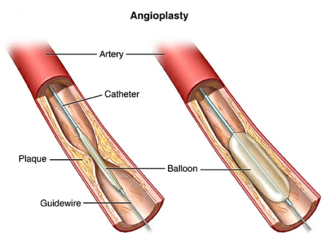 atherectomy