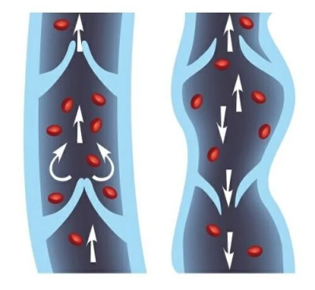 chronic venous insufficiency causes