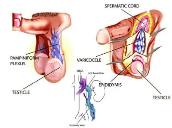 varicoceles testis