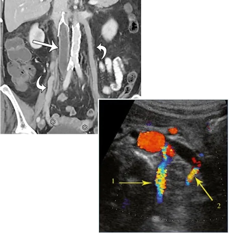 pelvic congestion syndrome diagnosed