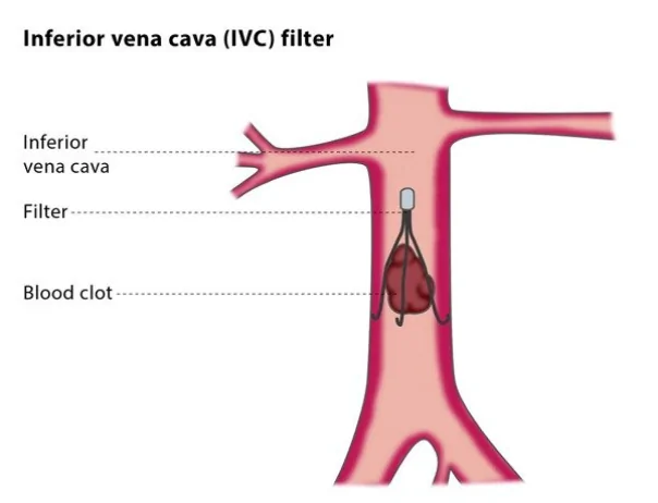 ivc filter placement