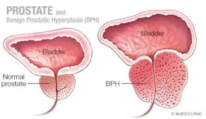 benign prostatic hyperplasia