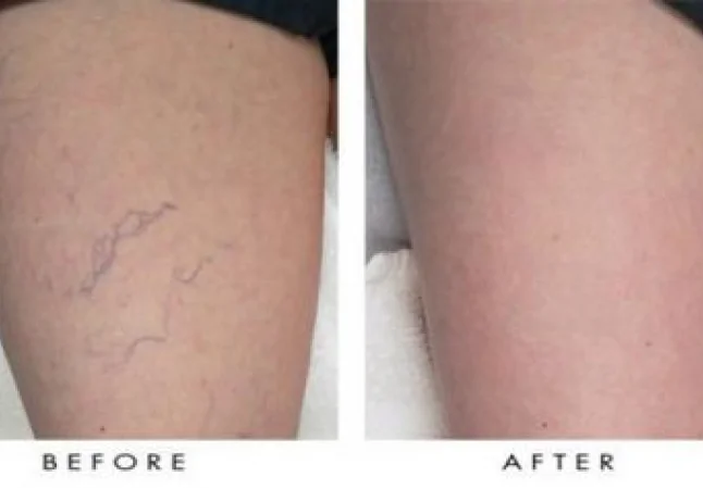 varicose veins treatment
