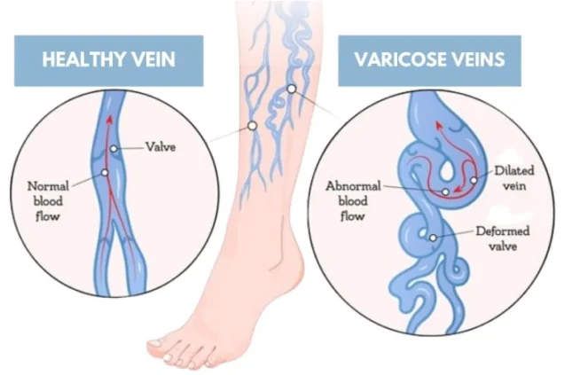 varicose veins risk factors