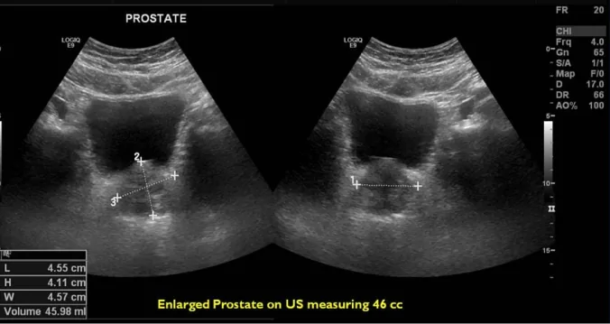 benign prostatic hyperplasia
