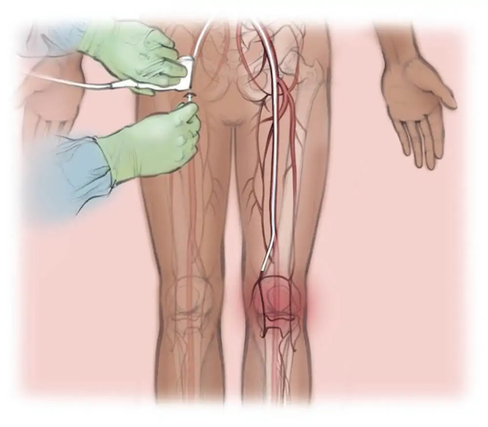genicular artery embo